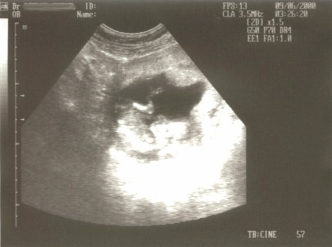 sonogram02.jpg (30778 bytes)